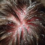 Effective Scalp Care for Seborrhea: Tips and Treatments