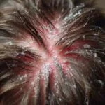 Effective Scalp Care for Seborrhea: Tips and Treatments
